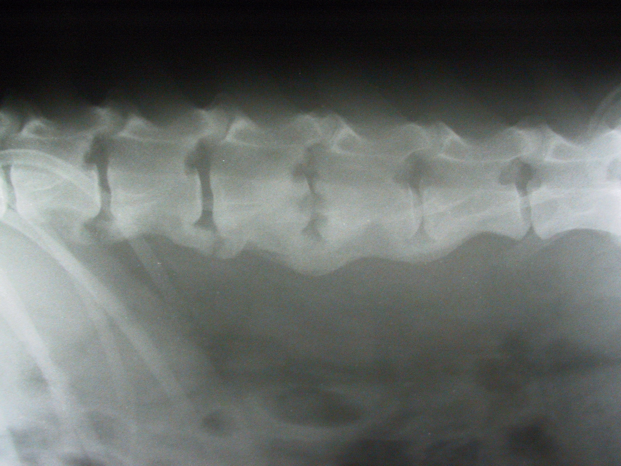 Spondyloarthrosen, Diskospondylitis